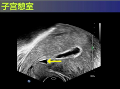 思普乐HRC专家：有子宫憩室，能做美国试管婴儿吗？