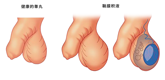 睾丸鞘膜积液