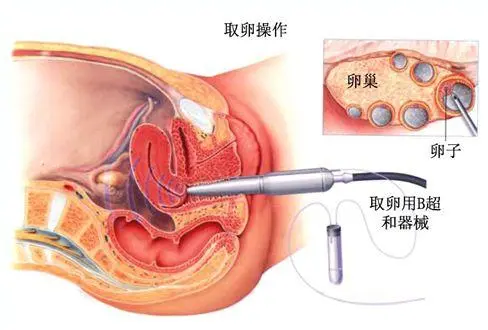 这六个步骤带你了解试管婴儿取卵的全过程