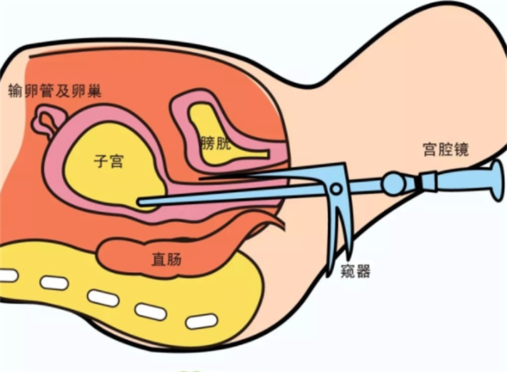 宫腔镜检查