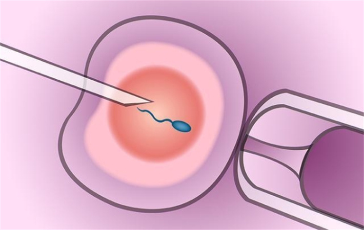 单精子注射技术