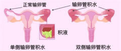 输卵管积水对美国试管促排卵和囊胚移植有影响吗？