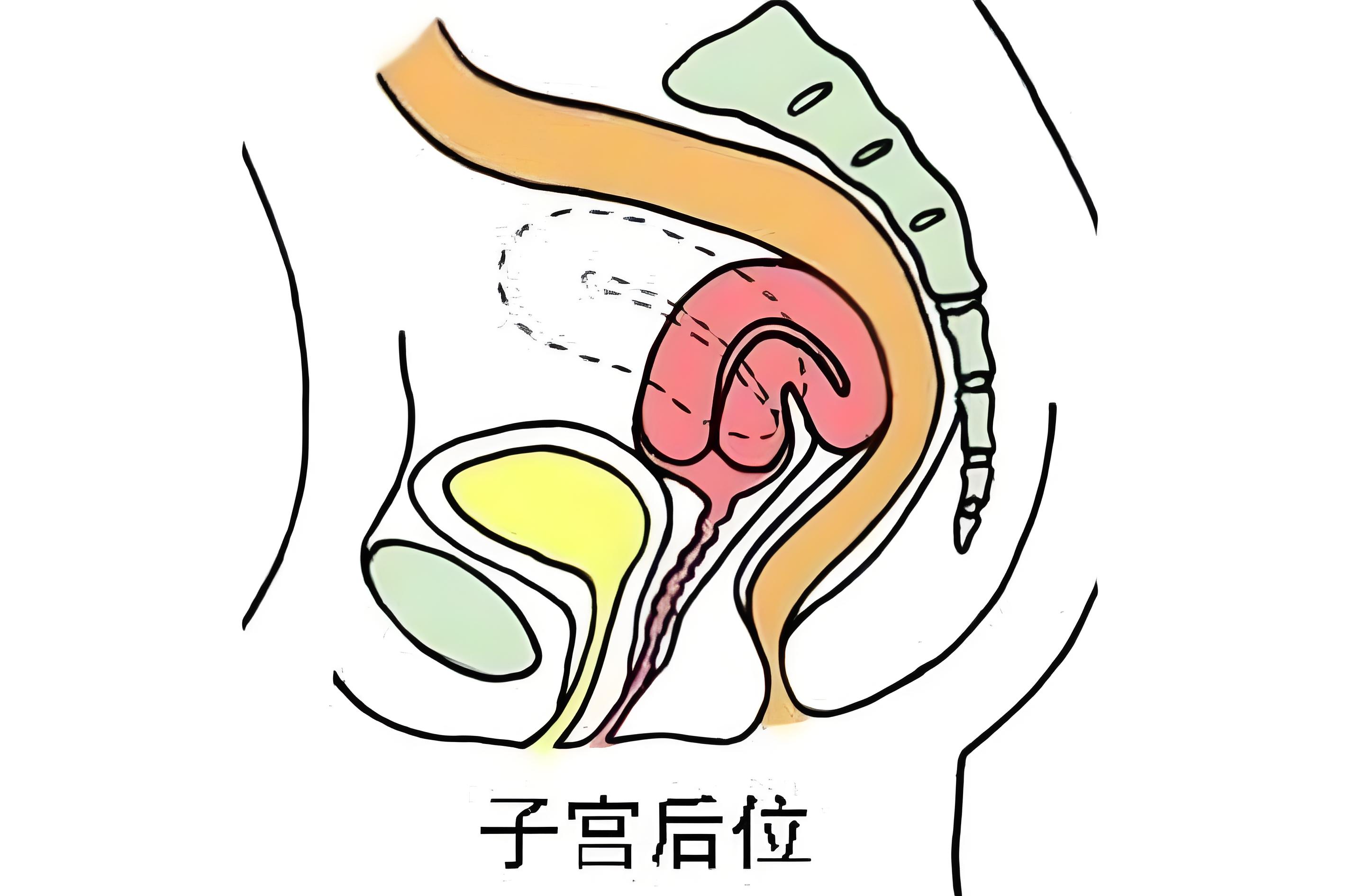 子宫后位