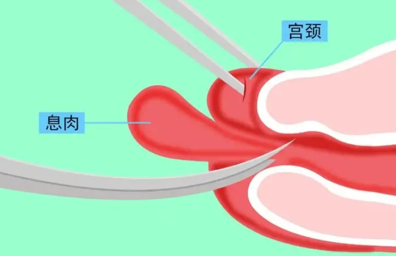 子宫内膜息肉.png