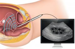 在美国试管婴儿期间做宫腔镜检查，有什么用？